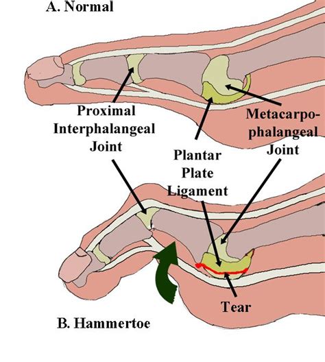 what is plantar plate dysfunction